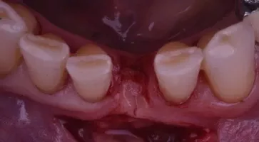 Photographie d'une dentition avec un dent manquante
