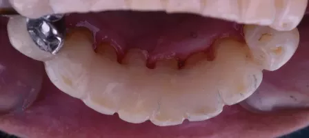 Photographie d'une dentition avec dent manquante collée