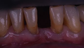 Photographie d'une dentition avec un dent manquante