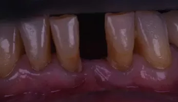 Photographie d'une dentition avec un dent manquante