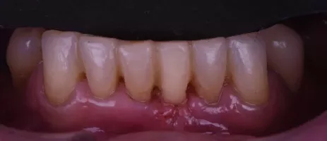 Photographie d'une dentition avec toutes les dents polies